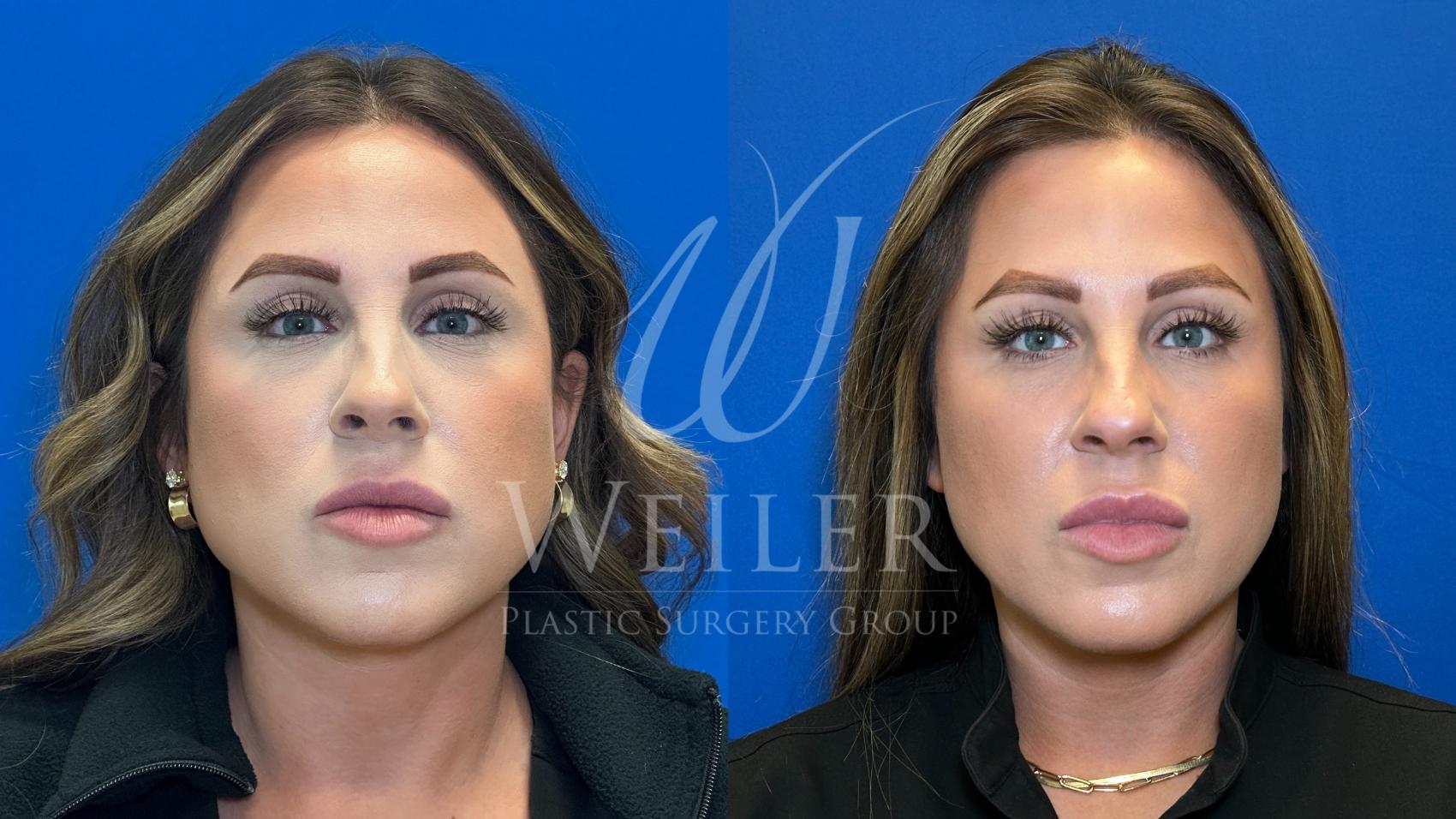 Before & After BOTOX® Cosmetic Case 1389 Front View in Baton Rouge, New Orleans, & Lafayette, Louisiana