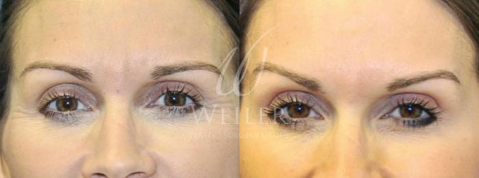 Before & After BOTOX® Cosmetic Case 14 View #1 View in Baton Rouge, New Orleans, & Lafayette, Louisiana