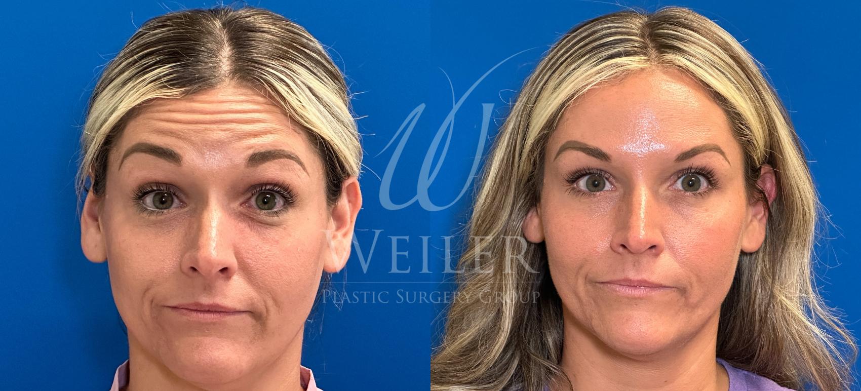 Before & After BOTOX® Cosmetic Case 1415 Front View in Baton Rouge, New Orleans, & Lafayette, Louisiana