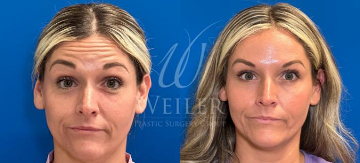 Before & After BOTOX® Cosmetic Case 1415 Front View in Baton Rouge, New Orleans, & Lafayette, Louisiana