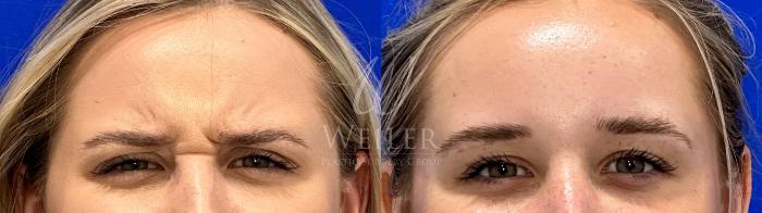 Before & After BOTOX® Cosmetic Case 1442 Front View in Baton Rouge, New Orleans, & Lafayette, Louisiana
