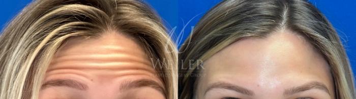 Before & After BOTOX® Cosmetic Case 1463 Front View in Baton Rouge, New Orleans, & Lafayette, Louisiana