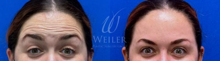 Before & After BOTOX® Cosmetic Case 1469 Front View in Baton Rouge, New Orleans, & Lafayette, Louisiana