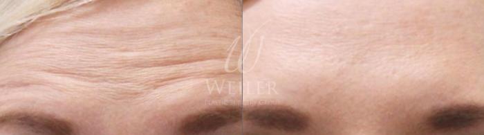 Before & After BOTOX® Cosmetic Case 15 View #1 View in Baton Rouge, New Orleans, & Lafayette, Louisiana