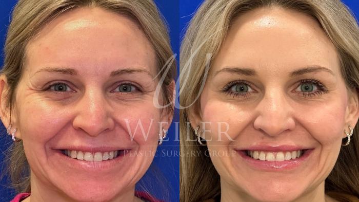 Before & After Lip Augmentation Case 1528 Front View in Baton Rouge, New Orleans, & Lafayette, Louisiana