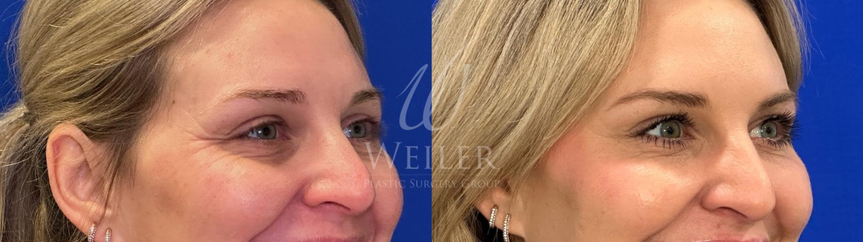 Before & After Lip Augmentation Case 1528 Right Oblique View in Baton Rouge, New Orleans, & Lafayette, Louisiana