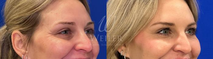 Before & After Lip Augmentation Case 1528 Right Oblique View in Baton Rouge, New Orleans, & Lafayette, Louisiana
