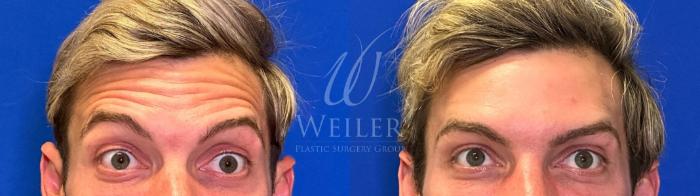Before & After BOTOX® Cosmetic Case 1537 Front View in Baton Rouge, New Orleans, & Lafayette, Louisiana