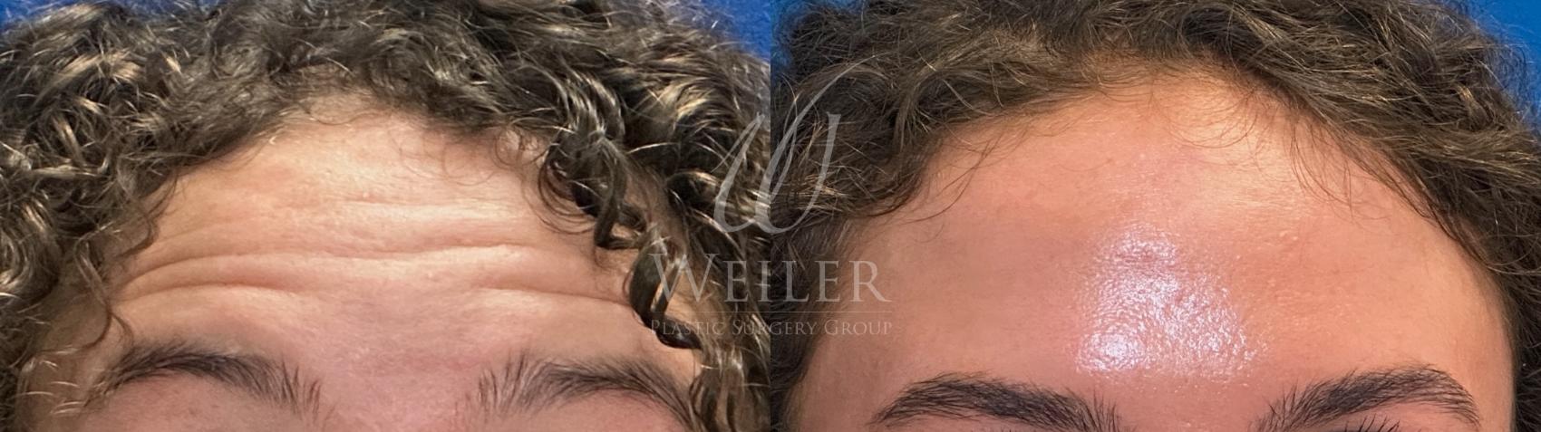 Before & After BOTOX® Cosmetic Case 1565 Front View in Baton Rouge, New Orleans, & Lafayette, Louisiana