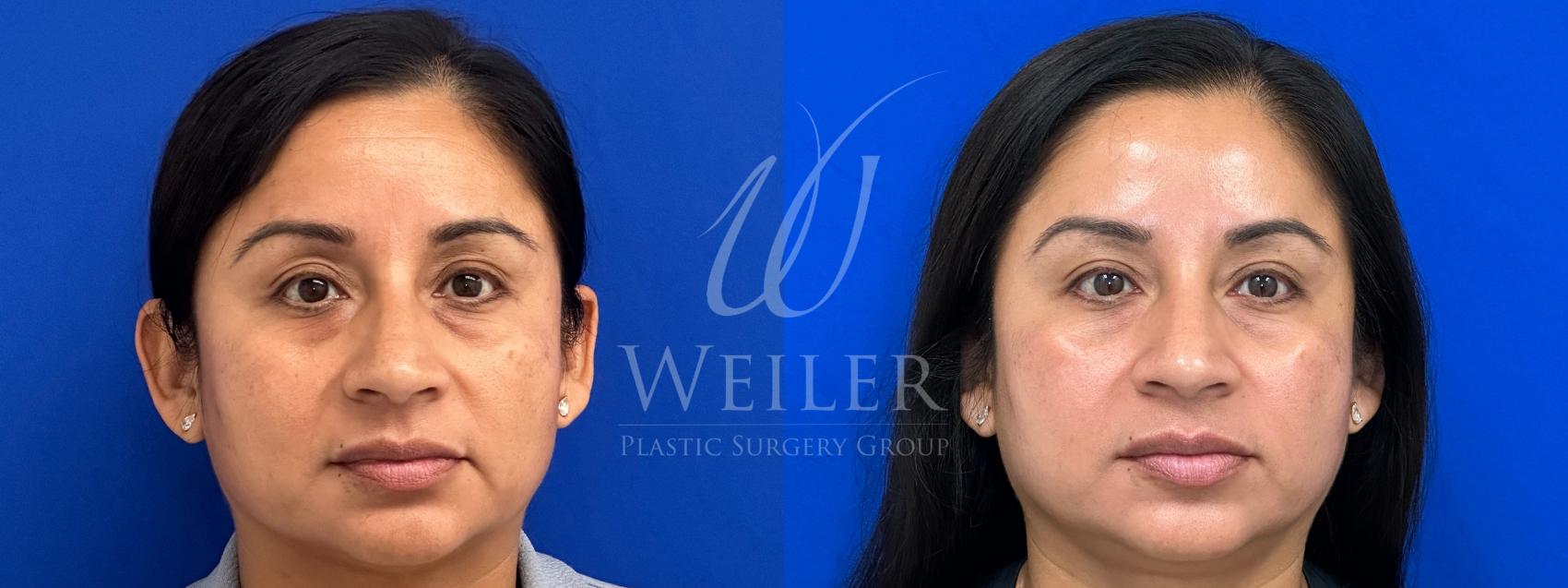 Before & After Medical Grade Skincare Case 1586 Front View in Baton Rouge, New Orleans, & Lafayette, Louisiana