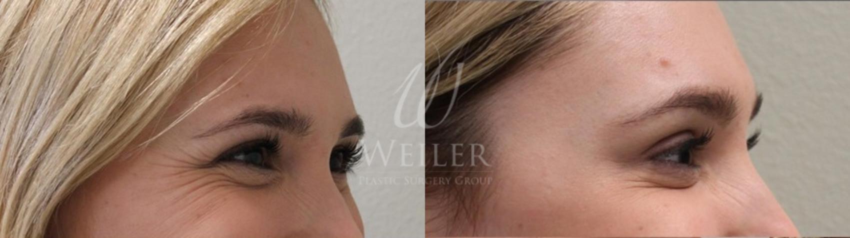 Before & After BOTOX® Cosmetic Case 16 View #1 View in Baton Rouge, New Orleans, & Lafayette, Louisiana