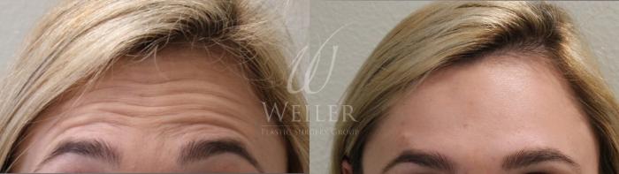 Before & After BOTOX® Cosmetic Case 16 View #2 View in Baton Rouge, New Orleans, & Lafayette, Louisiana