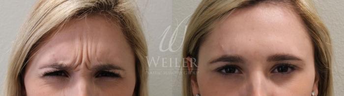 Before & After BOTOX® Cosmetic Case 16 View #3 View in Baton Rouge, New Orleans, & Lafayette, Louisiana
