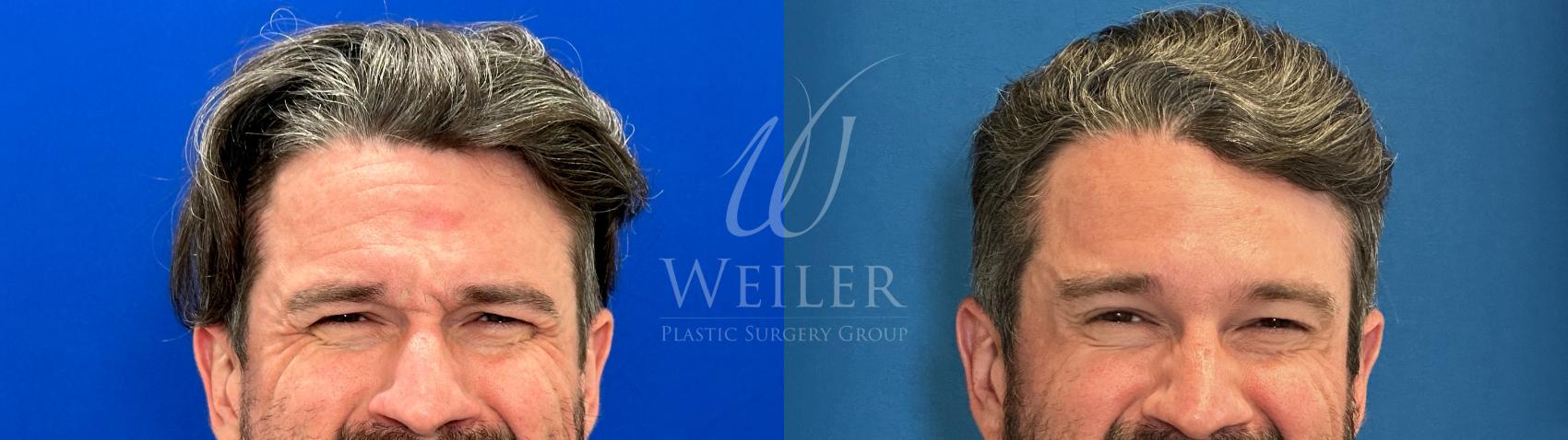 Before & After BOTOX® Cosmetic Case 1608 Front View in Baton Rouge, New Orleans, & Lafayette, Louisiana