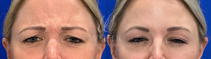 Before & After JUVÉDERM® Case 1648 Front View in Baton Rouge, New Orleans, & Lafayette, Louisiana