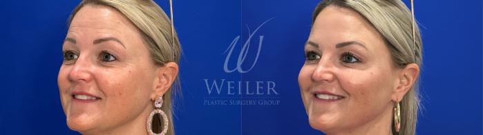 Before & After JUVÉDERM® Case 1648 Left Oblique View in Baton Rouge, New Orleans, & Lafayette, Louisiana