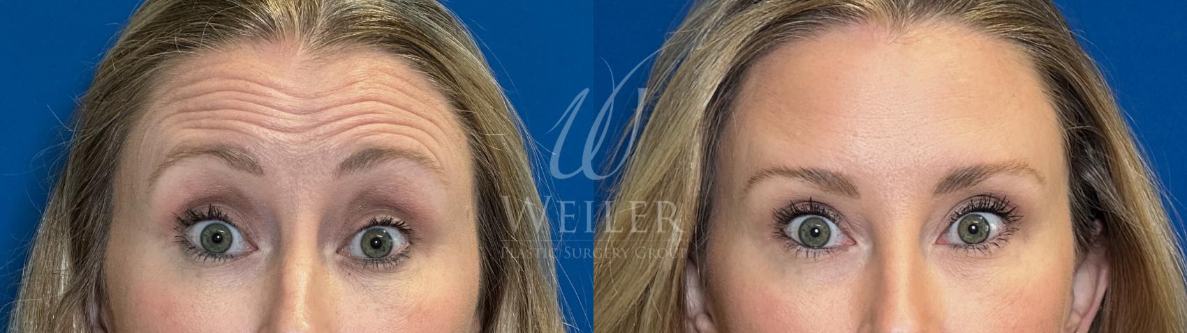 Before & After BOTOX® Cosmetic Case 1687 Front View in Baton Rouge, New Orleans, & Lafayette, Louisiana