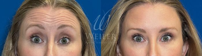 Before & After BOTOX® Cosmetic Case 1687 Front View in Baton Rouge, New Orleans, & Lafayette, Louisiana