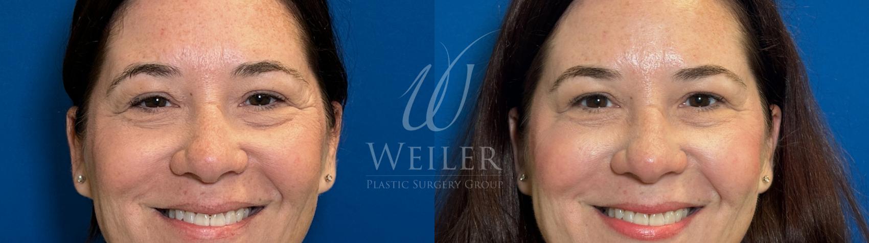Before & After BOTOX® Cosmetic Case 1705 Front View in Baton Rouge, New Orleans, & Lafayette, Louisiana