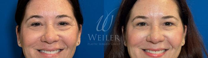 Before & After BOTOX® Cosmetic Case 1705 Front View in Baton Rouge, New Orleans, & Lafayette, Louisiana