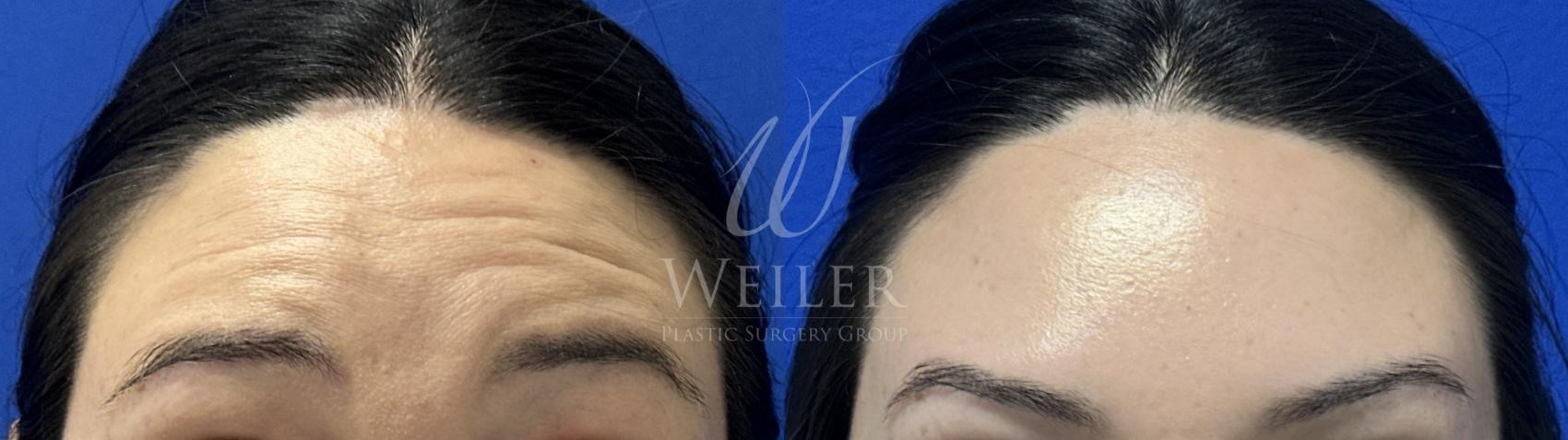 Before & After BOTOX® Cosmetic Case 1805 Front View in Baton Rouge, New Orleans, & Lafayette, Louisiana