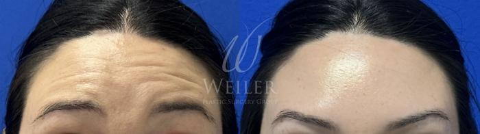 Before & After BOTOX® Cosmetic Case 1805 Front View in Baton Rouge, New Orleans, & Lafayette, Louisiana