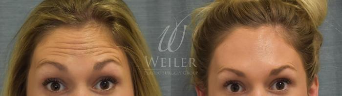 Before & After BOTOX® Cosmetic Case 358 View #1 View in Baton Rouge, New Orleans, & Lafayette, Louisiana