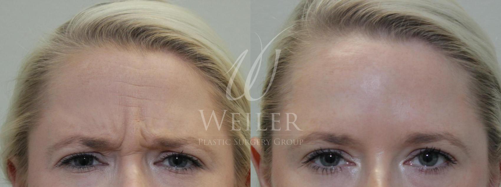 Before & After BOTOX® Cosmetic Case 359 View #1 View in Baton Rouge, New Orleans, & Lafayette, Louisiana