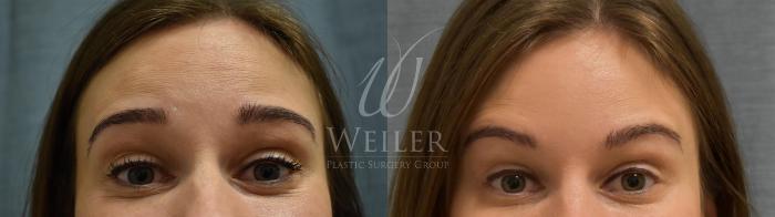 Before & After BOTOX® Cosmetic Case 364 View #1 View in Baton Rouge, New Orleans, & Lafayette, Louisiana