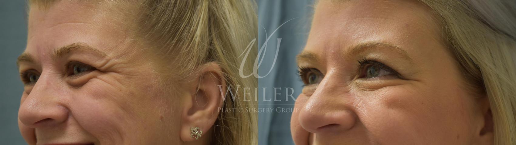 Before & After BOTOX® Cosmetic Case 365 View #1 View in Baton Rouge, Louisiana