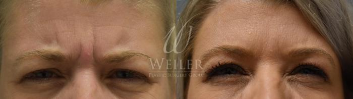 Before & After BOTOX® Cosmetic Case 366 View #1 View in Baton Rouge, Louisiana