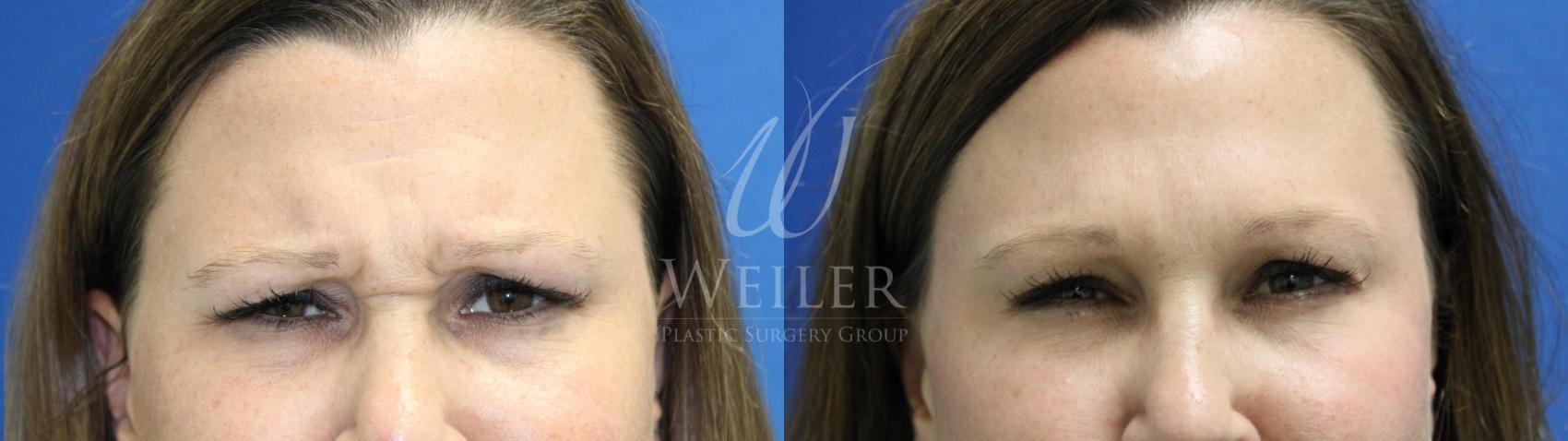 Before & After BOTOX® Cosmetic Case 458 View #1 View in Baton Rouge, New Orleans, & Lafayette, Louisiana