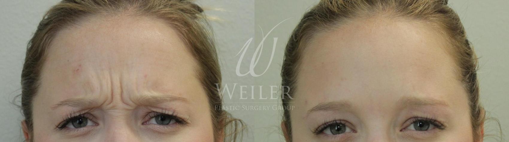 Before & After BOTOX® Cosmetic Case 459 View #1 View in Baton Rouge, Louisiana