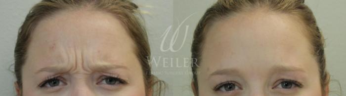 Before & After BOTOX® Cosmetic Case 459 View #1 View in Baton Rouge, Louisiana