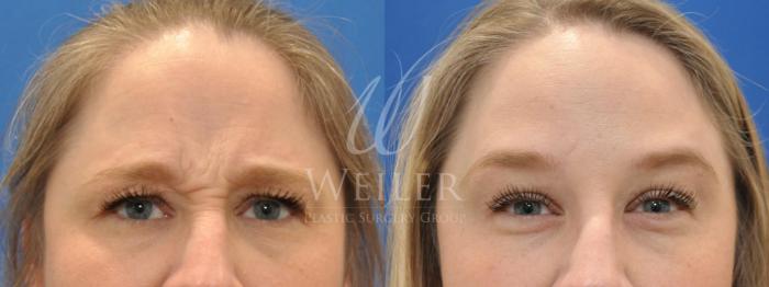 Before & After BOTOX® Cosmetic Case 492 Front View in Baton Rouge, Louisiana