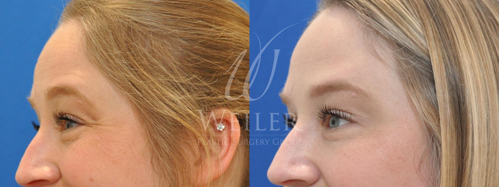 Before & After BOTOX® Cosmetic Case 492 Left Side View in Baton Rouge, Louisiana