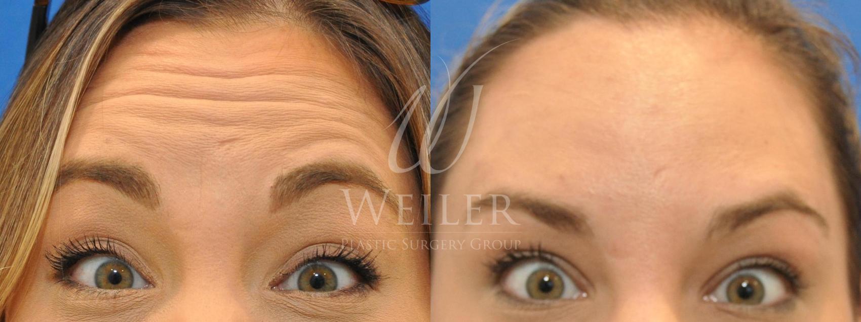Before & After BOTOX® Cosmetic Case 509 Front View in Baton Rouge, New Orleans, & Lafayette, Louisiana