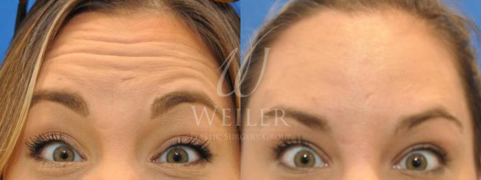 Before & After BOTOX® Cosmetic Case 509 Front View in Baton Rouge, New Orleans, & Lafayette, Louisiana