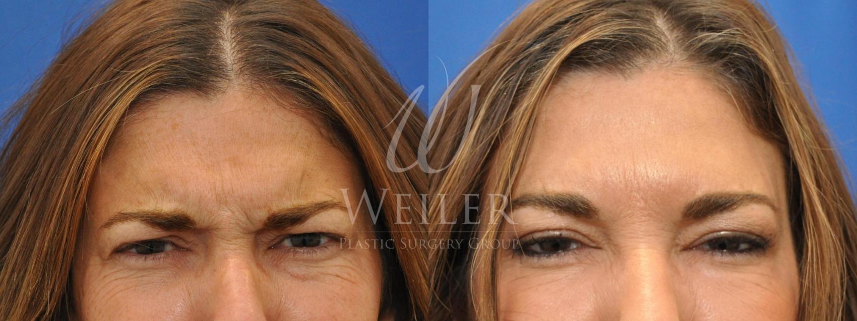 Before & After BOTOX® Cosmetic Case 510 Front View in Baton Rouge, Louisiana