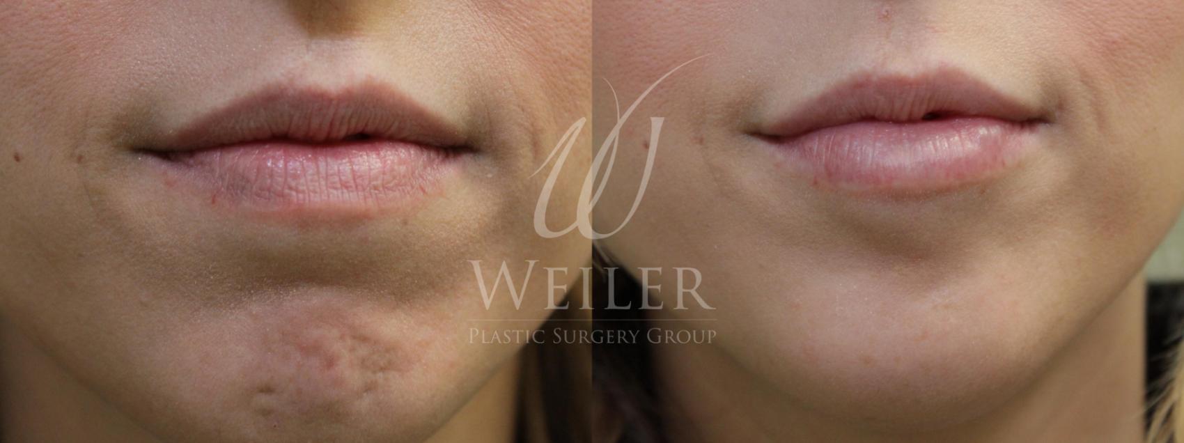 Before & After BOTOX® Cosmetic Case 517 Front View in Baton Rouge, New Orleans, & Lafayette, Louisiana