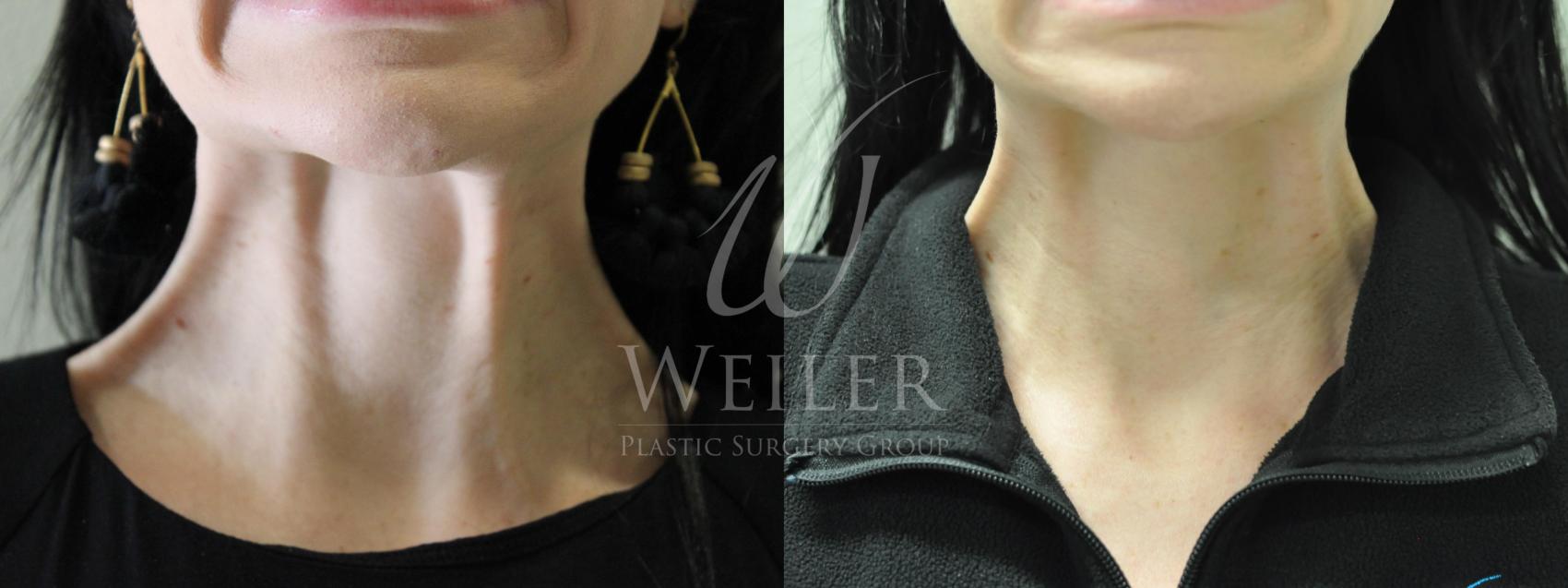 Before & After BOTOX® Cosmetic Case 518 Front View in Baton Rouge, Louisiana