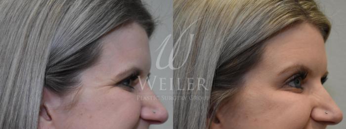 Before & After BOTOX® Cosmetic Case 521 Left Side View in Baton Rouge, Louisiana