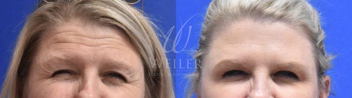 Before & After BOTOX® Cosmetic Case 547 Front View in Baton Rouge, Louisiana