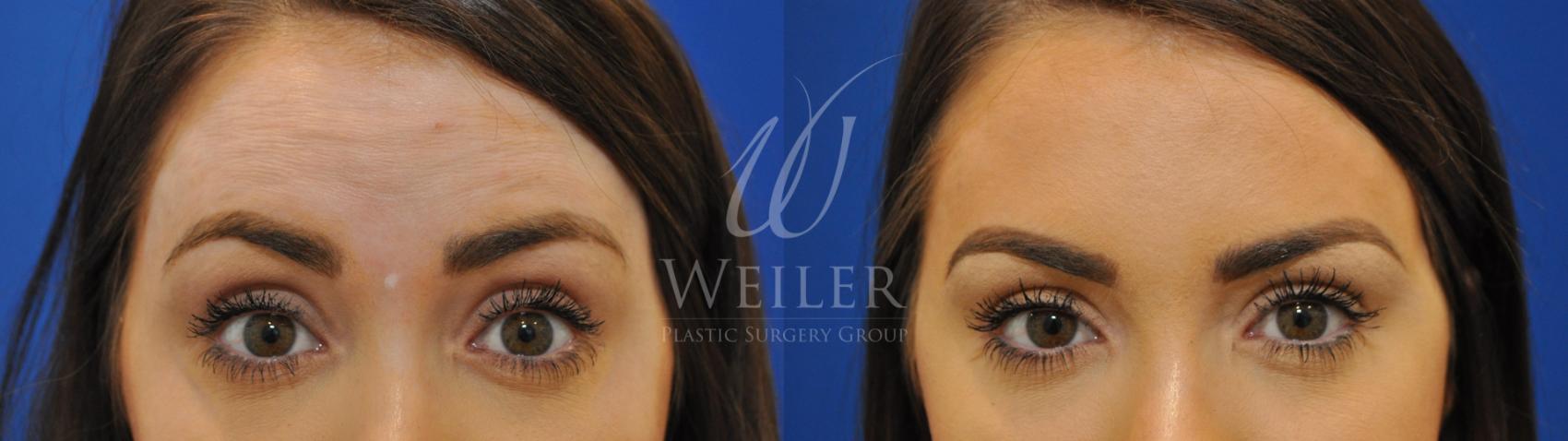Before & After BOTOX® Cosmetic Case 548 Front View in Baton Rouge, New Orleans, & Lafayette, Louisiana