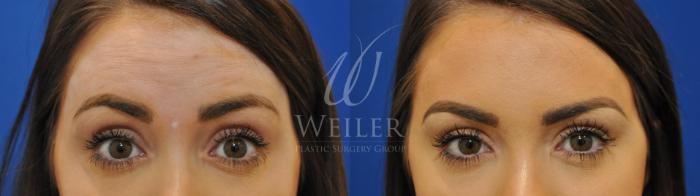 Before & After BOTOX® Cosmetic Case 548 Front View in Baton Rouge, New Orleans, & Lafayette, Louisiana