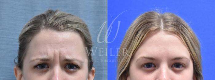 Before & After BOTOX® Cosmetic Case 561 Front View in Baton Rouge, New Orleans, & Lafayette, Louisiana
