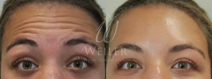 Before & After BOTOX® Cosmetic Case 562 Front View in Baton Rouge, New Orleans, & Lafayette, Louisiana