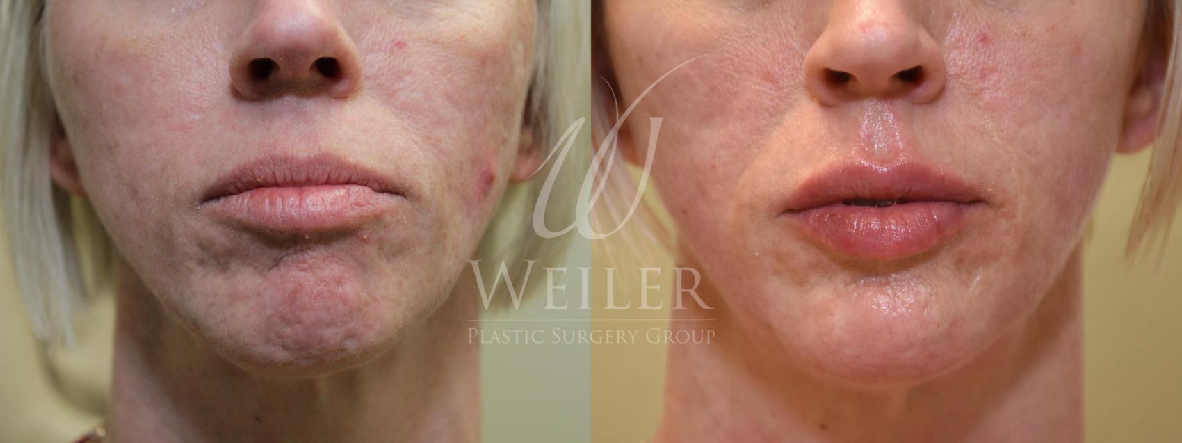 Before & After BOTOX® Cosmetic Case 613 Front View in Baton Rouge, New Orleans, & Lafayette, Louisiana