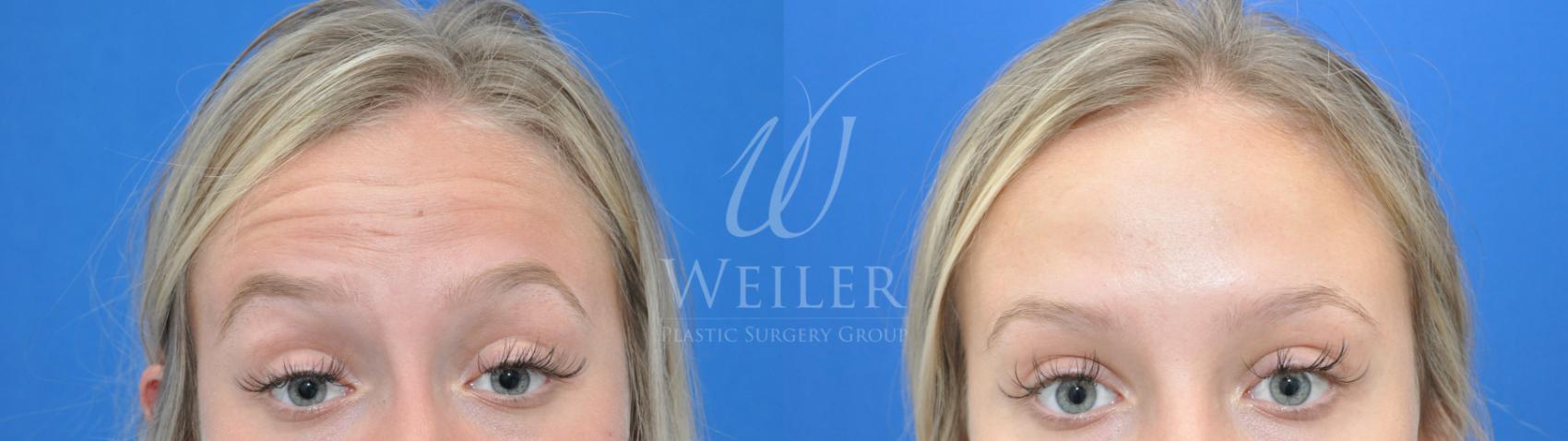 Before & After BOTOX® Cosmetic Case 652 Front View in Baton Rouge, Louisiana