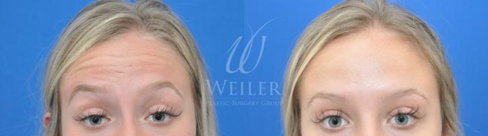 Before & After BOTOX® Cosmetic Case 652 Front View in Baton Rouge, New Orleans, & Lafayette, Louisiana